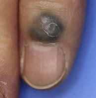Image result for Cancer On Finger