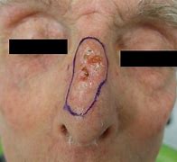 Image result for Basal Cell Carcinoma Skin Cancer Nose