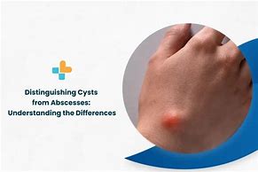 Image result for Cyst vs Abscess
