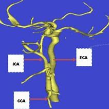 Image result for Carotid Artery Model