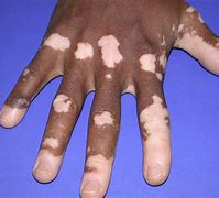 Image result for Human Lotus Pod Skin Disease