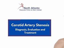 Image result for Carotid Artery Exact Location