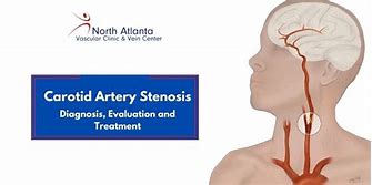Image result for Stenosis of Carotid Artery
