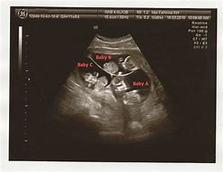 Image result for Triplet Ultrasound 12 Weeks