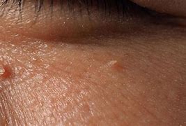 Image result for Papilloma Eyelid Wart