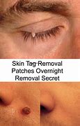 Image result for Eyelid Skin Tag Remover
