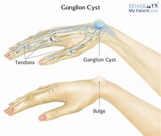 Image result for Benign Tumor in Wrist