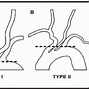 Image result for Carotid Artery Stent Surgery