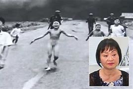 Image result for Napalm Girl burn treatment