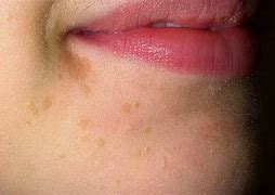 Image result for Flat Warts