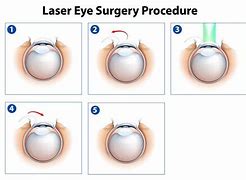 Image result for Lasik Surgery Diagram