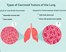 Image result for Atypical Carcinoid