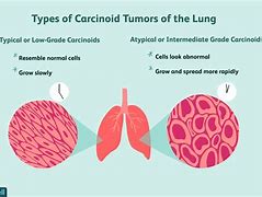 Image result for Is a Tumor Cancer