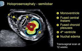 Image result for Holoprosencephaly Ultrasound Images