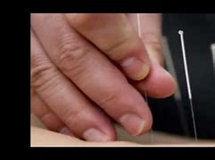 Image result for acupyntura
