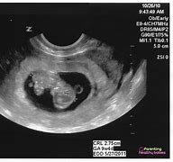 Image result for Ultrasound at 9 Weeks Pregnant