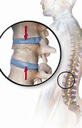 Image result for Lumbar Spine Fracture Treatment