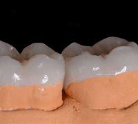 Image result for Overlay Dental