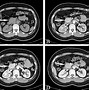 Image result for Pancreatic Cyst Size