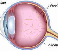 Image result for Eye Floaters Treatment