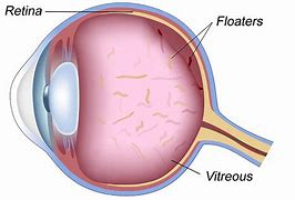 Image result for Eye Floaters Solution