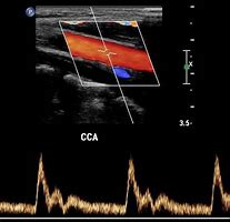Image result for Carotid Doppler Ultrasound