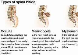 Image result for Spina Bifida Anatomy