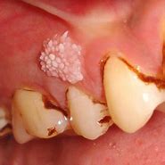 Image result for Tongue Warts