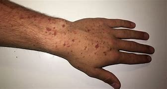 Image result for Rash and Blisters On Arm