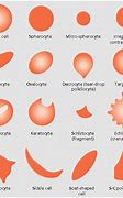 Image result for Abnormal Red Blood Cells Shape