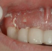 Image result for Tooth Extraction Bone Showing