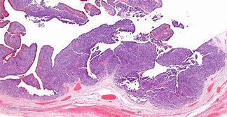 Image result for Ovarian Cancer Cells