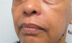 Image result for Pigmented Basal Cell Carcinoma On Black Skin