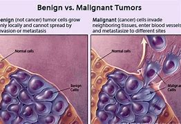 Image result for Benign Tumors Metastasize