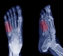 Image result for 5th Metatarsal Stress Fracture