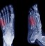 Image result for 5th Metatarsal Jones Fracture Foot