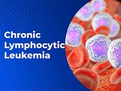 Image result for Chronic Lymphocytic Leukemia Disease