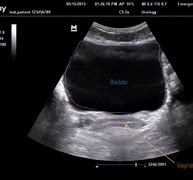 Image result for Pelvic Ultrasound Pregnancy
