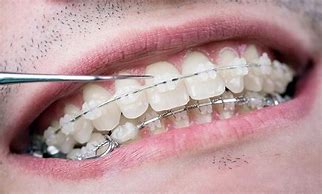 Image result for Ceramic Teeth Braces