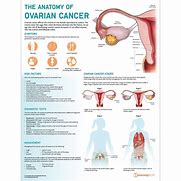Image result for Ovarian Cancer Diagram