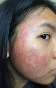 Image result for Allergic Reaction Hives On Face