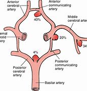 Image result for Intracranial Aneurysm