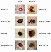 Image result for HPV Skin Cancer