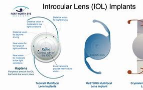 Image result for Intraocular Lens Surgery
