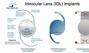 Image result for Cataract Surgery Intraocular Lens