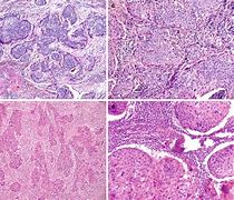 Image result for Squamous Cell Carcinoma Cervical Cancer