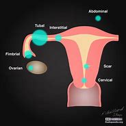 Image result for Cervical Ectropion