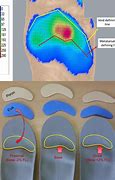 Image result for Orthotics for Metatarsal Pain