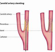 Image result for Carotid Angioplasty and Stenting Protective Cap