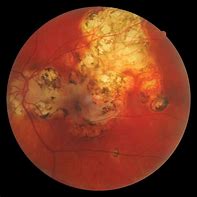 Image result for Retinal Scarring